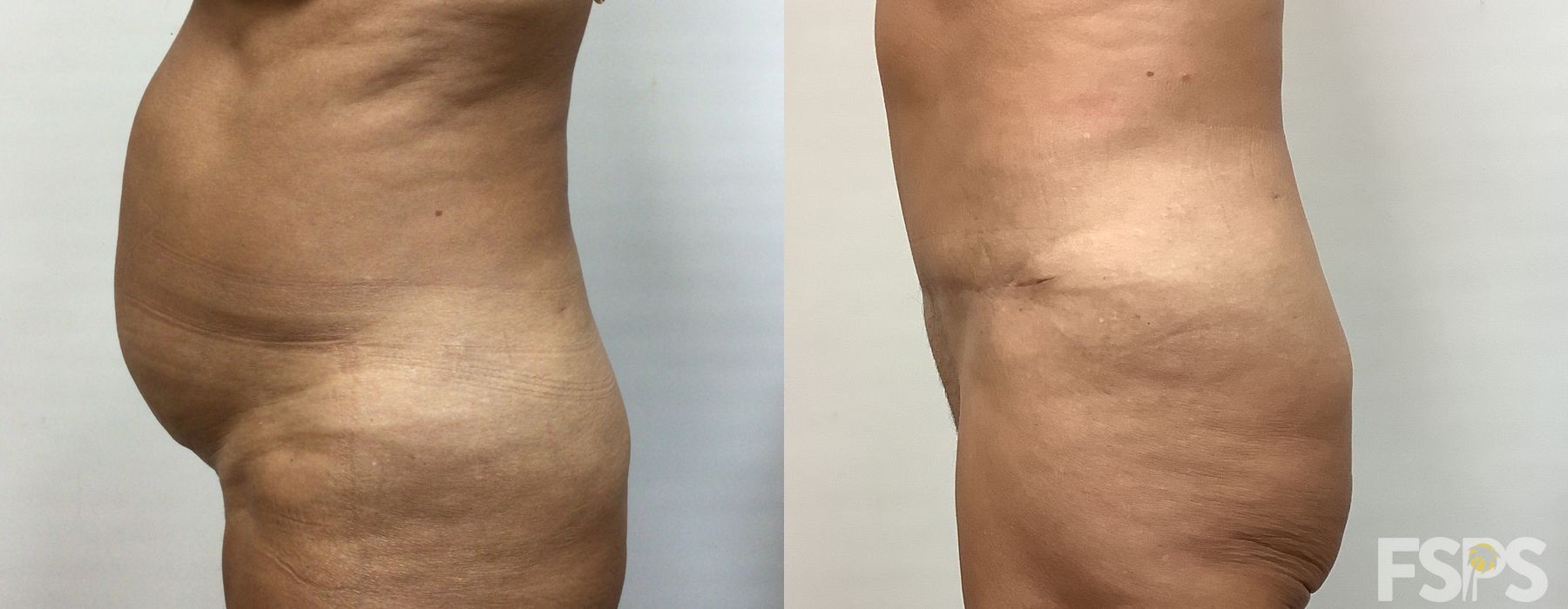 Tummy Tuck - Thumbnail 2