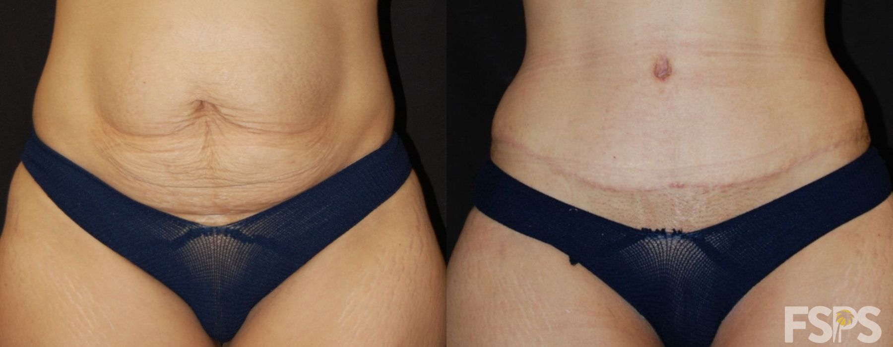 Before and after Tummy Tuck case 17627