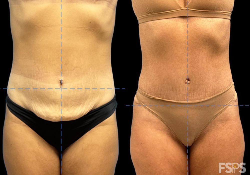Tummy Tuck - Case 22928