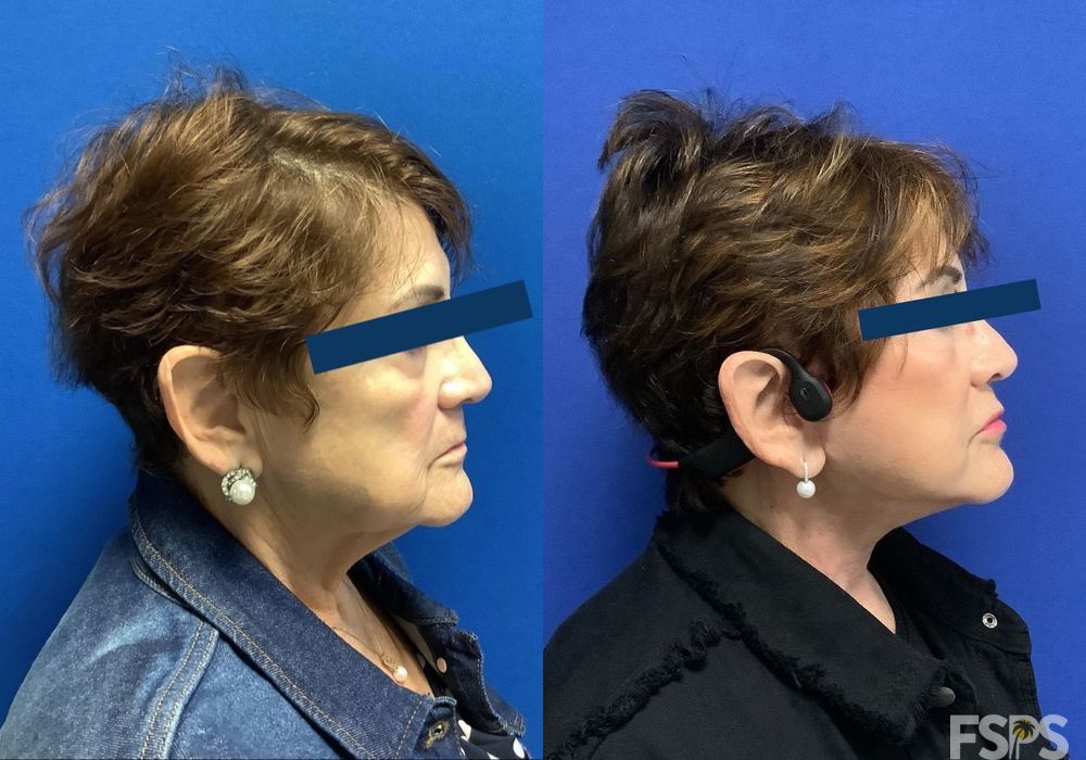 Neck Lift - Thumbnail 2