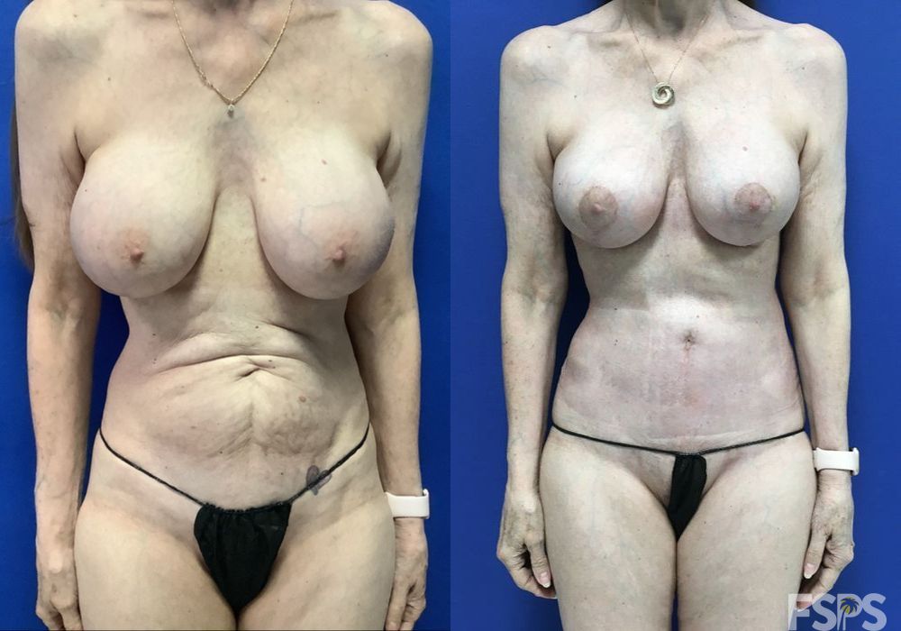 Breast Lift - Thumbnail 2