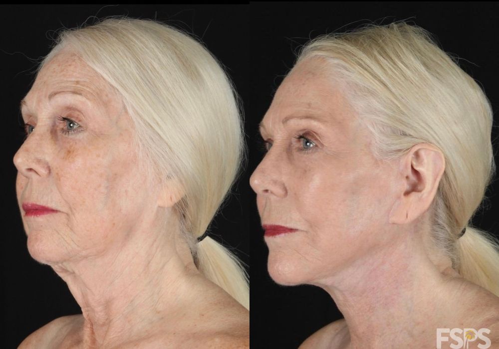 Neck Lift - Thumbnail 2