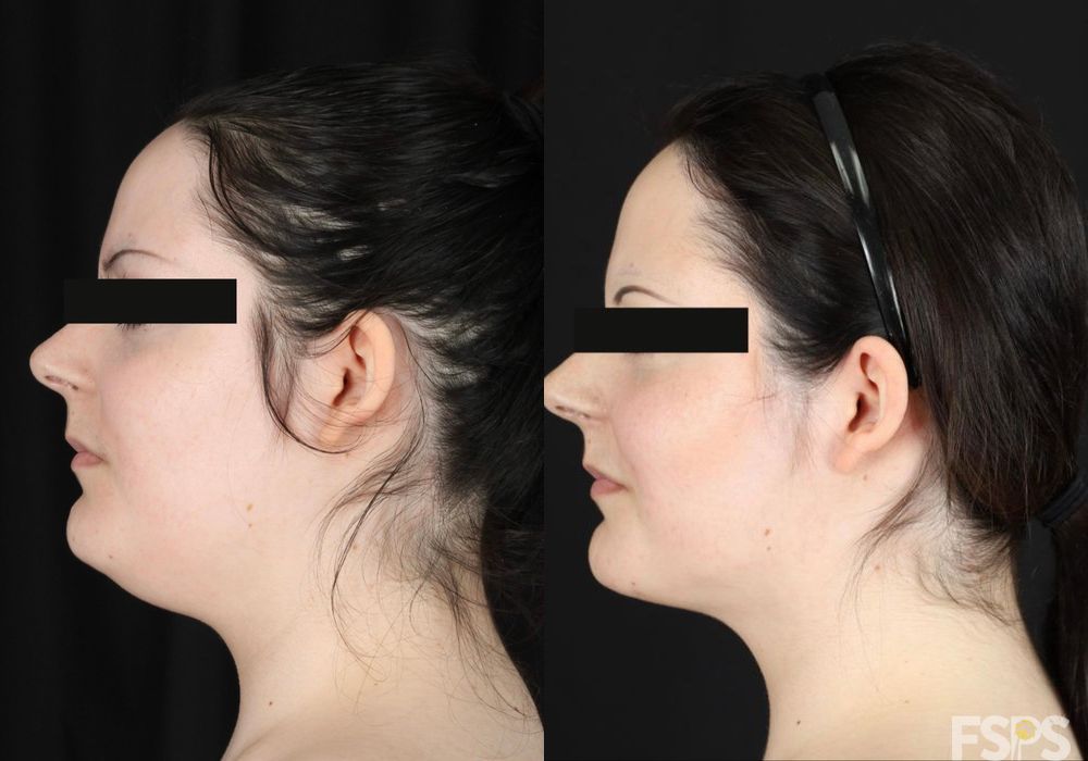 Liposuction - Thumbnail 3