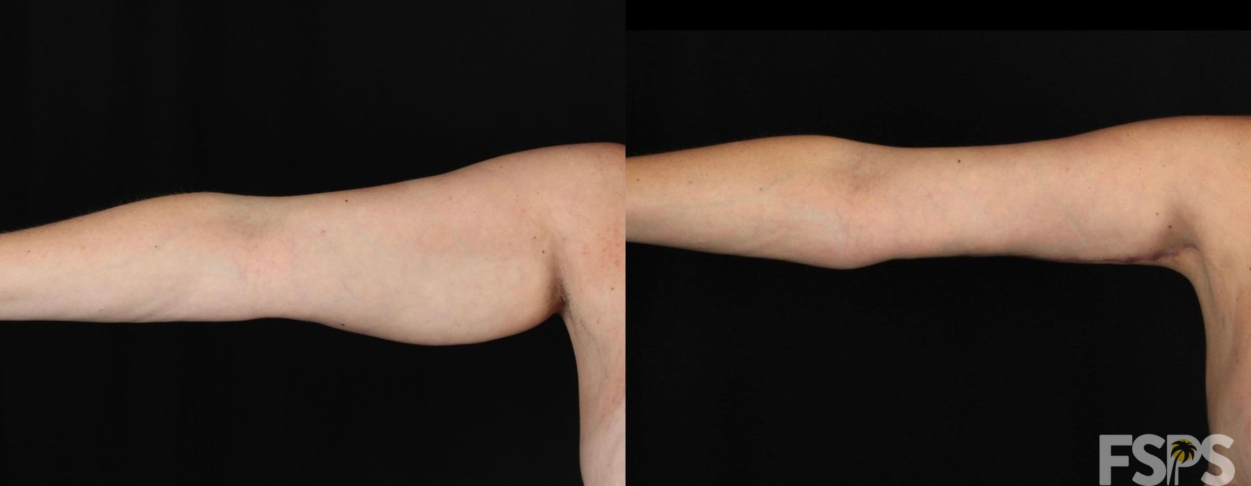 Liposuction - Case 22608