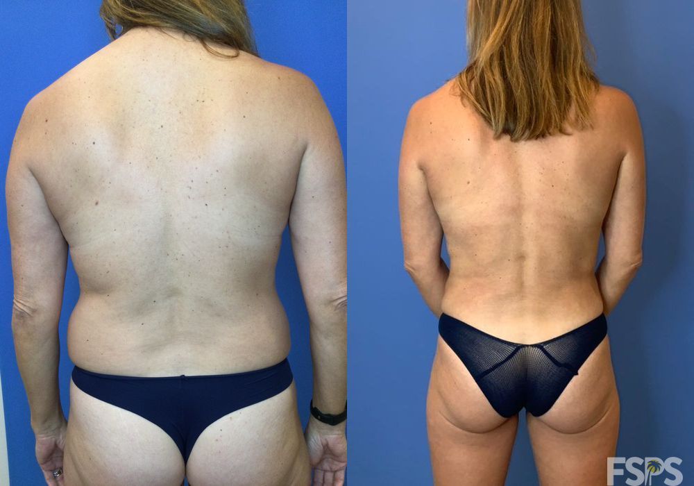Liposuction - Case 22734