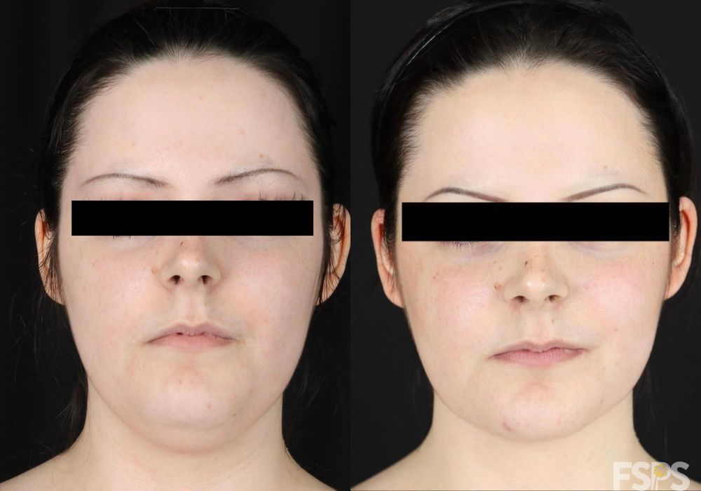 Liposuction - Case 22607