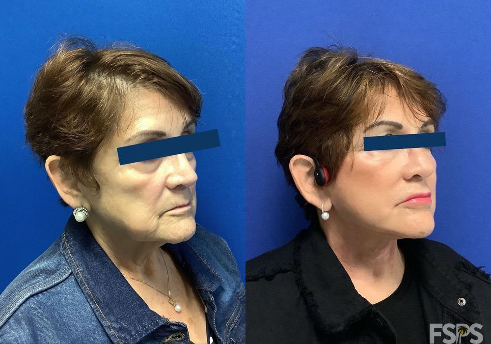 Neck Lift - Thumbnail 3