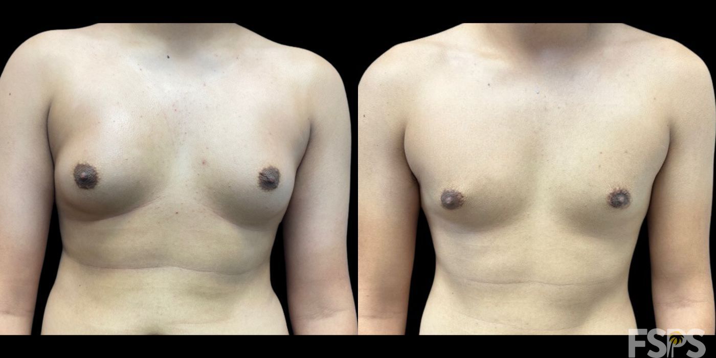 Gynecomastia - Case 22810