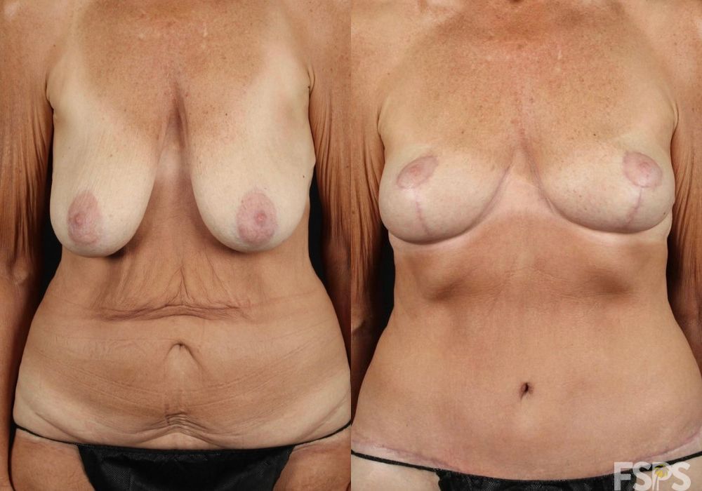 Breast Lift - Thumbnail 2