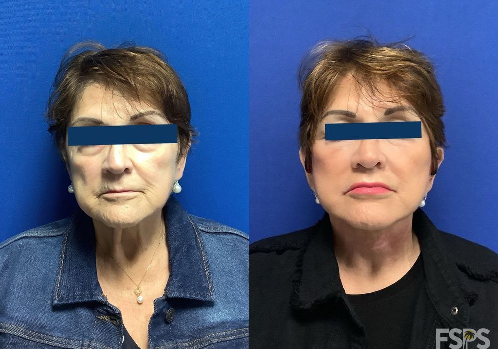 Neck Lift - Case 22830