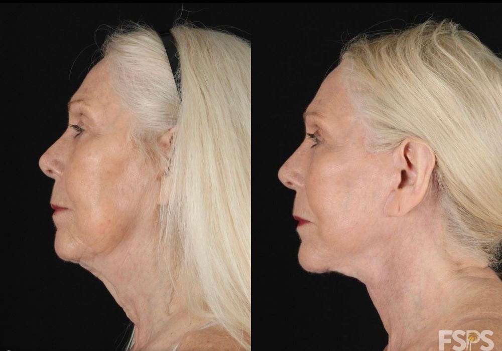 Neck Lift - Case 22697