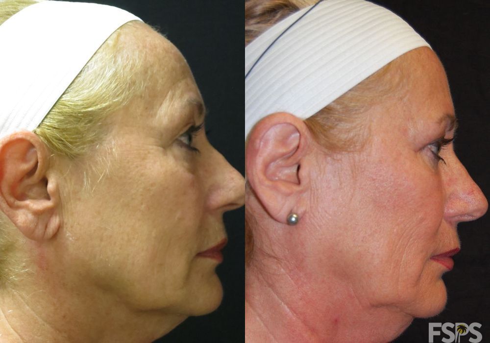 Blepharoplasty - Thumbnail 4