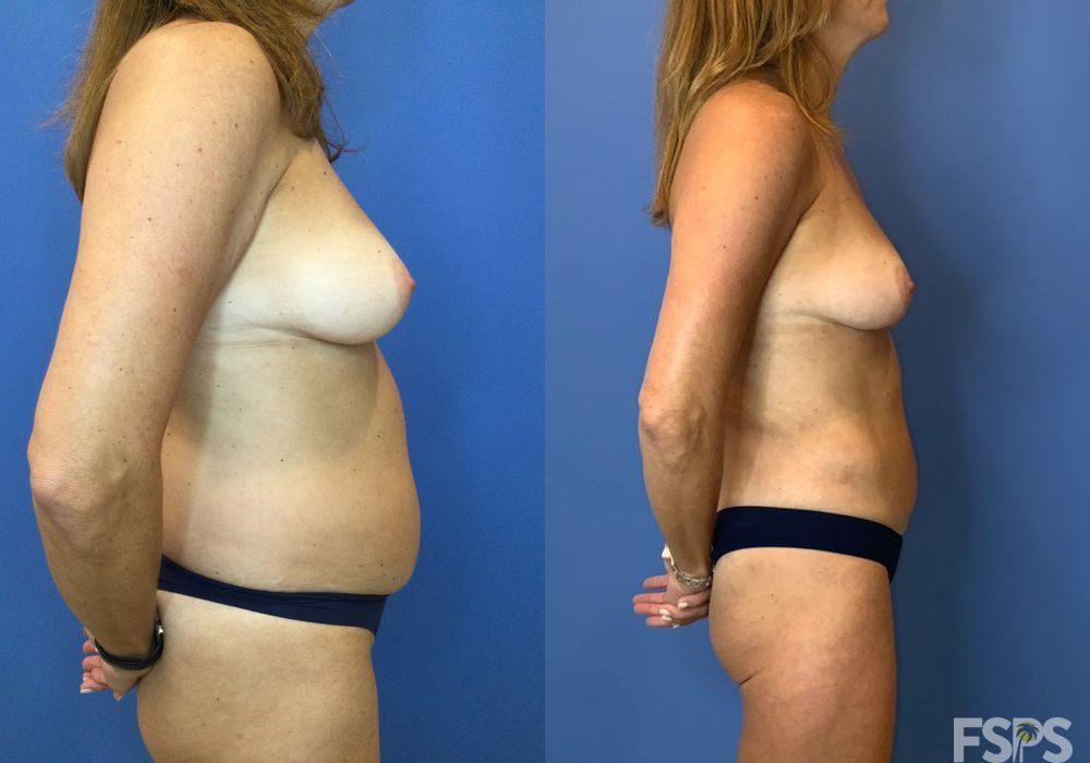 Liposuction - Thumbnail 5