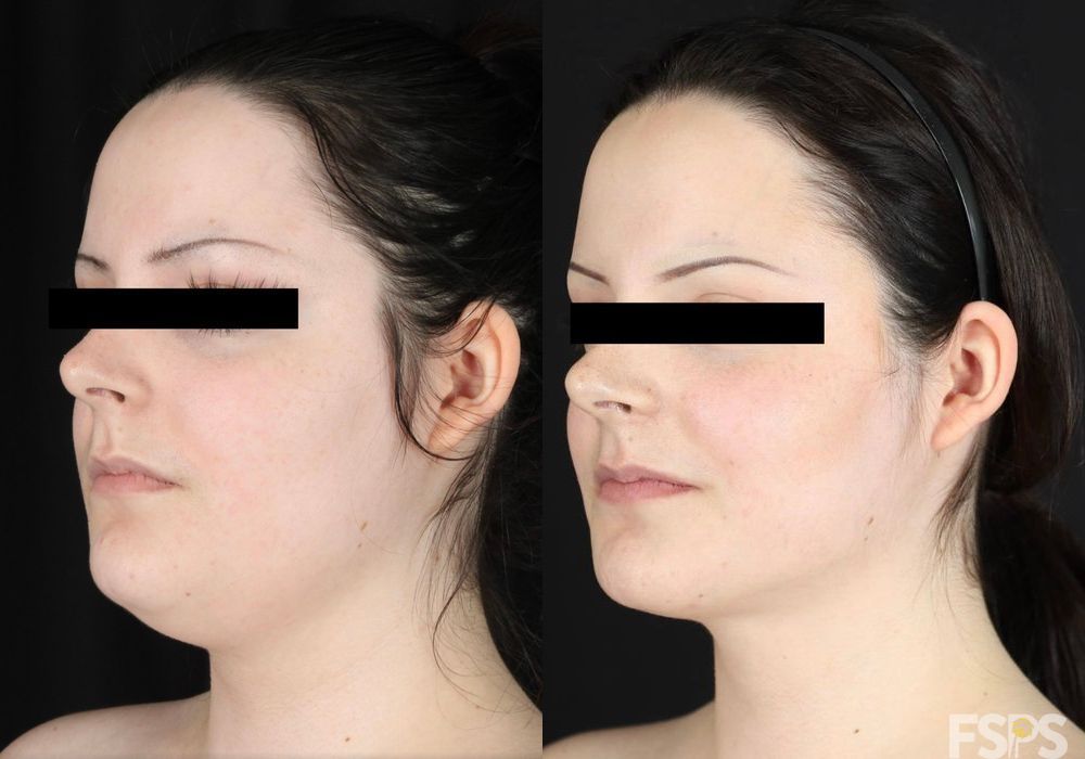 Liposuction - Thumbnail 2