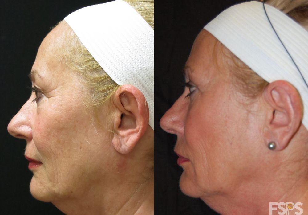 Blepharoplasty - Thumbnail 3