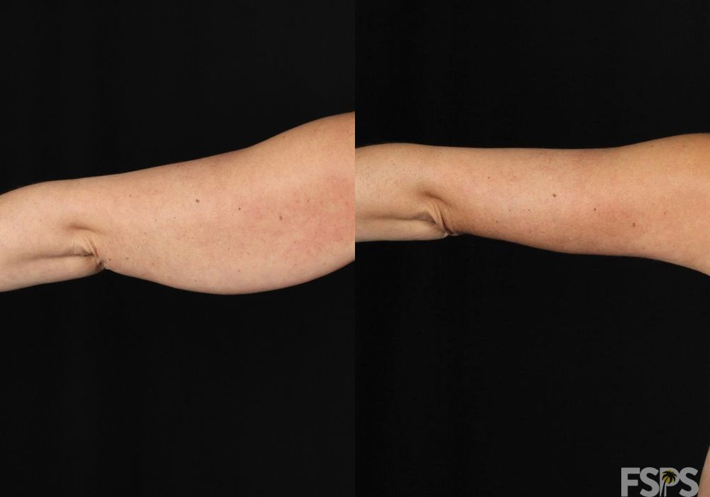 Liposuction - Thumbnail 2