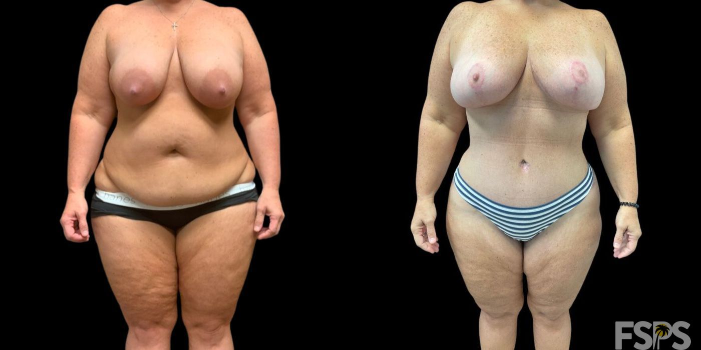 Mommy Makeover - Case 22746