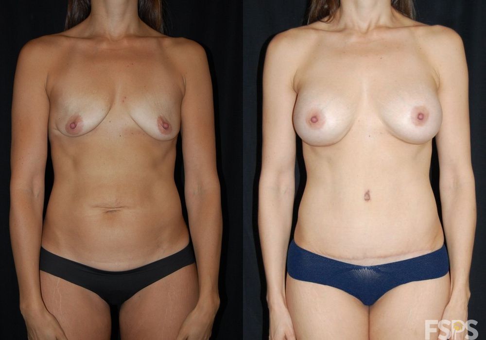 Breast Augmentation - Case 22770
