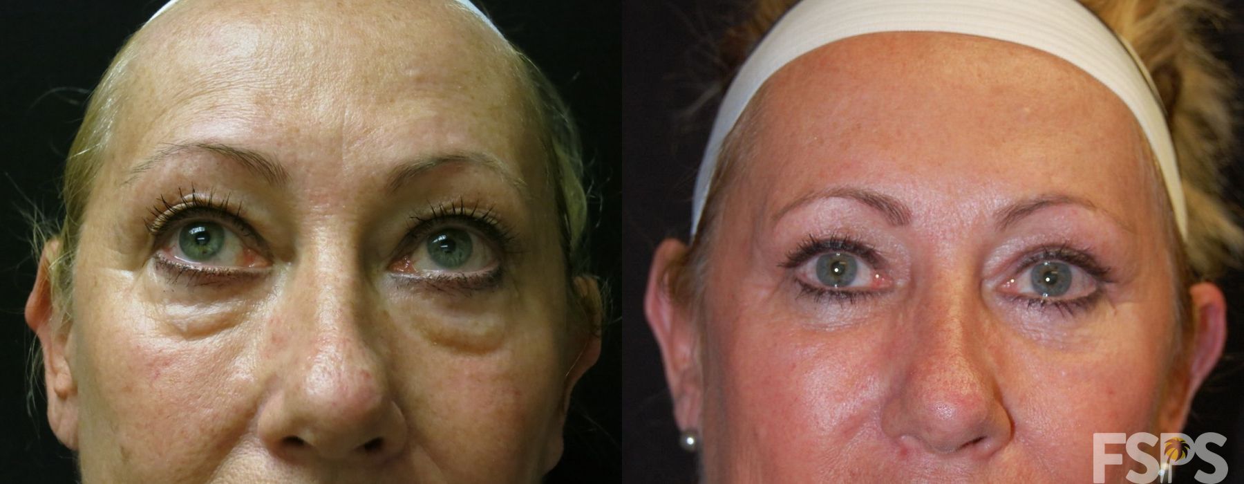 Blepharoplasty - Thumbnail 2