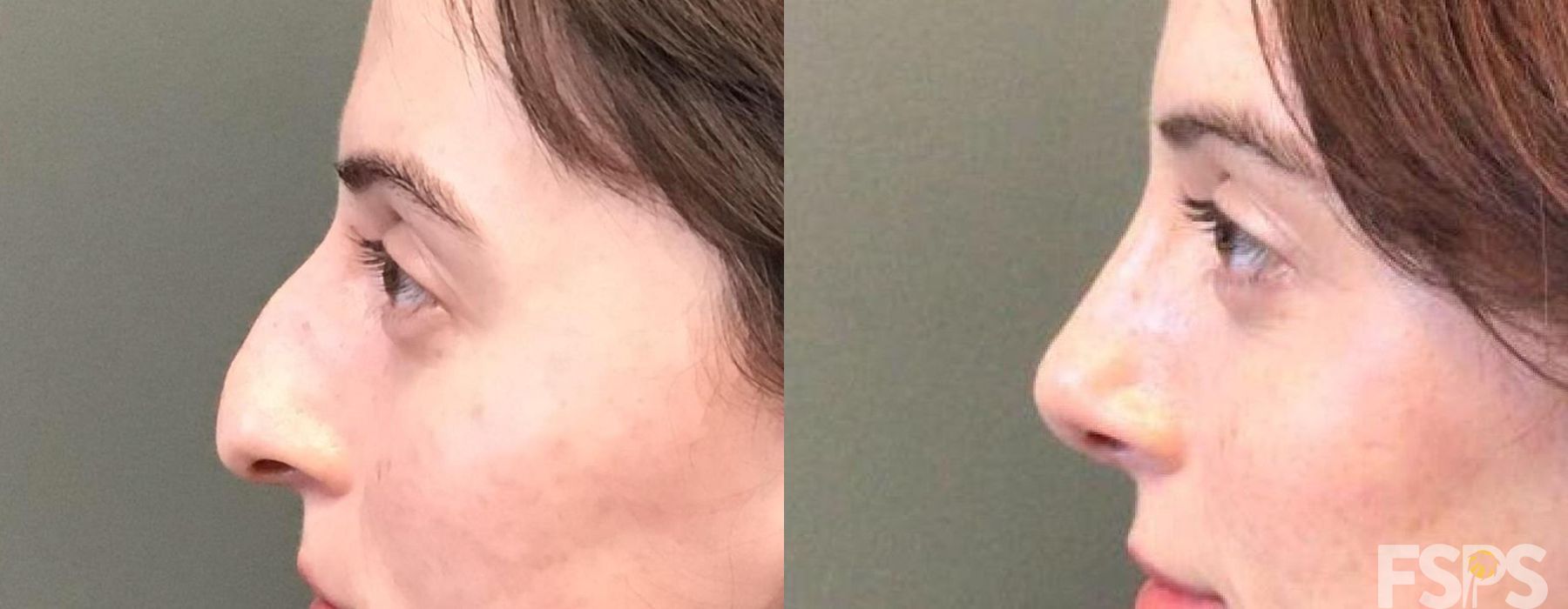 Rhinoplasty - Case 22835