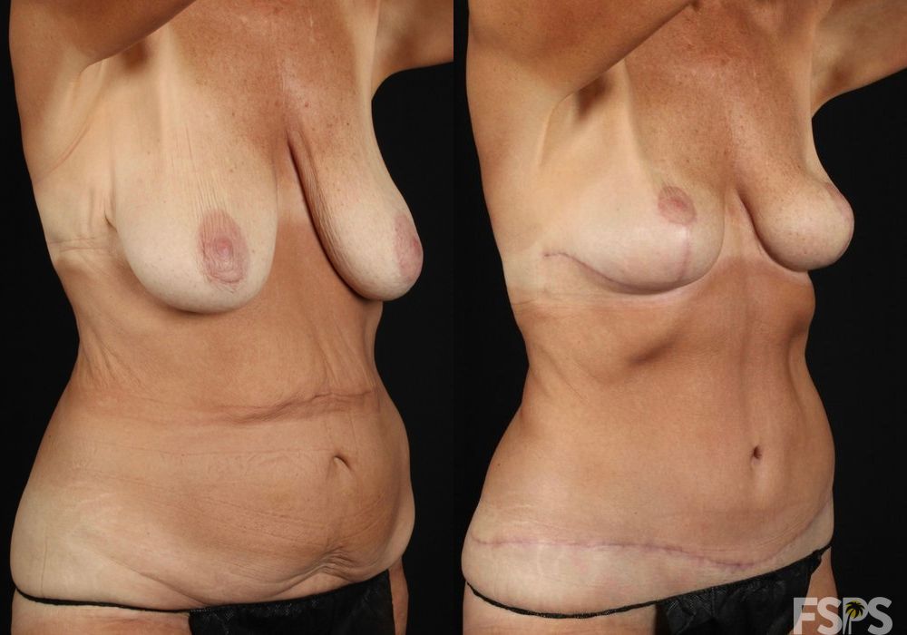 Breast Lift - Case 22788
