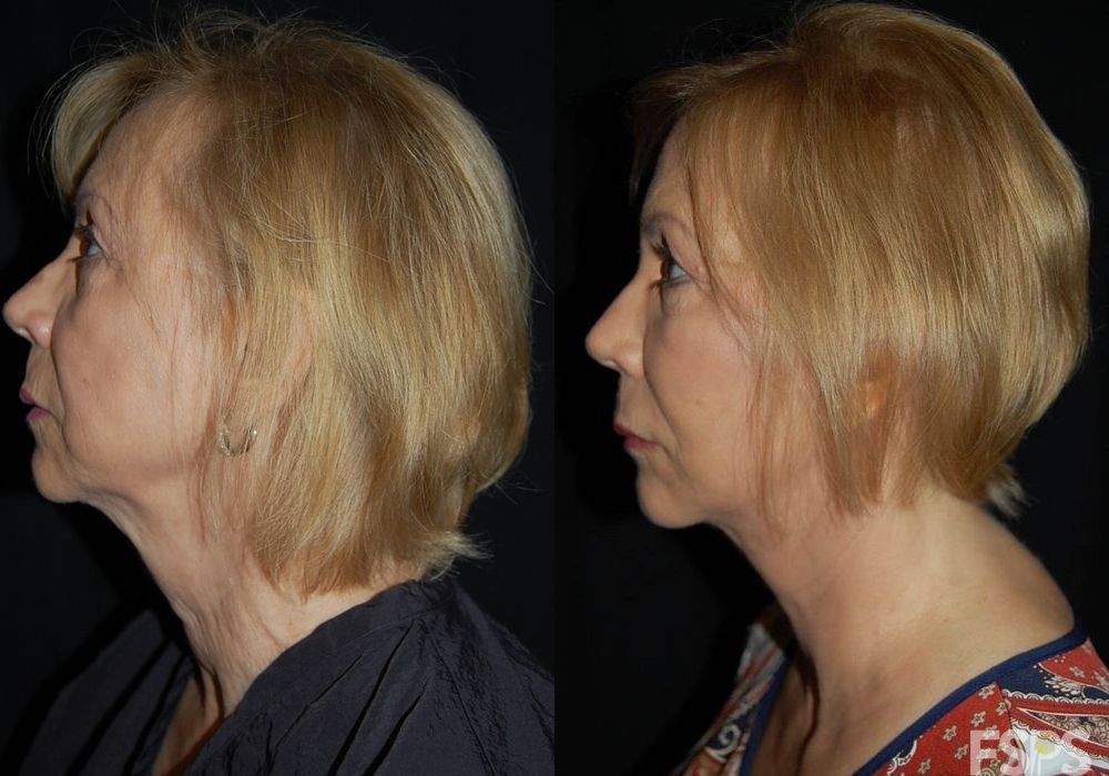 Facelift - Thumbnail 4