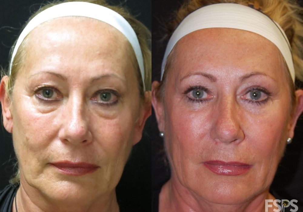 Blepharoplasty - Case 22684
