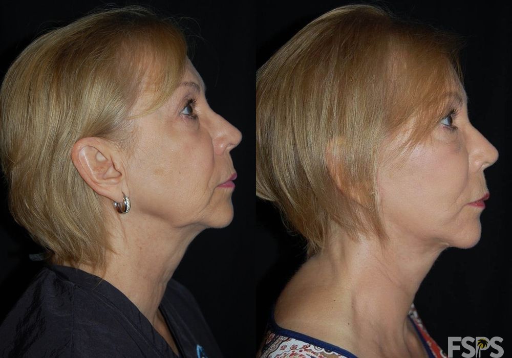 Facelift - Case 22822