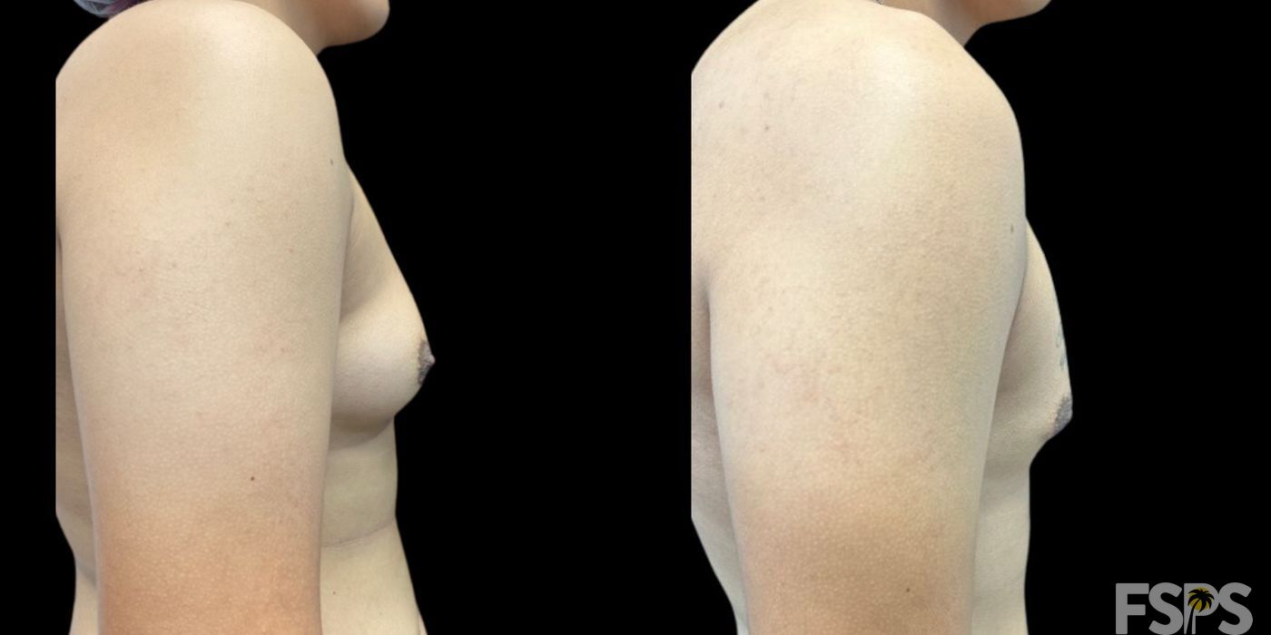 Gynecomastia - Thumbnail 2