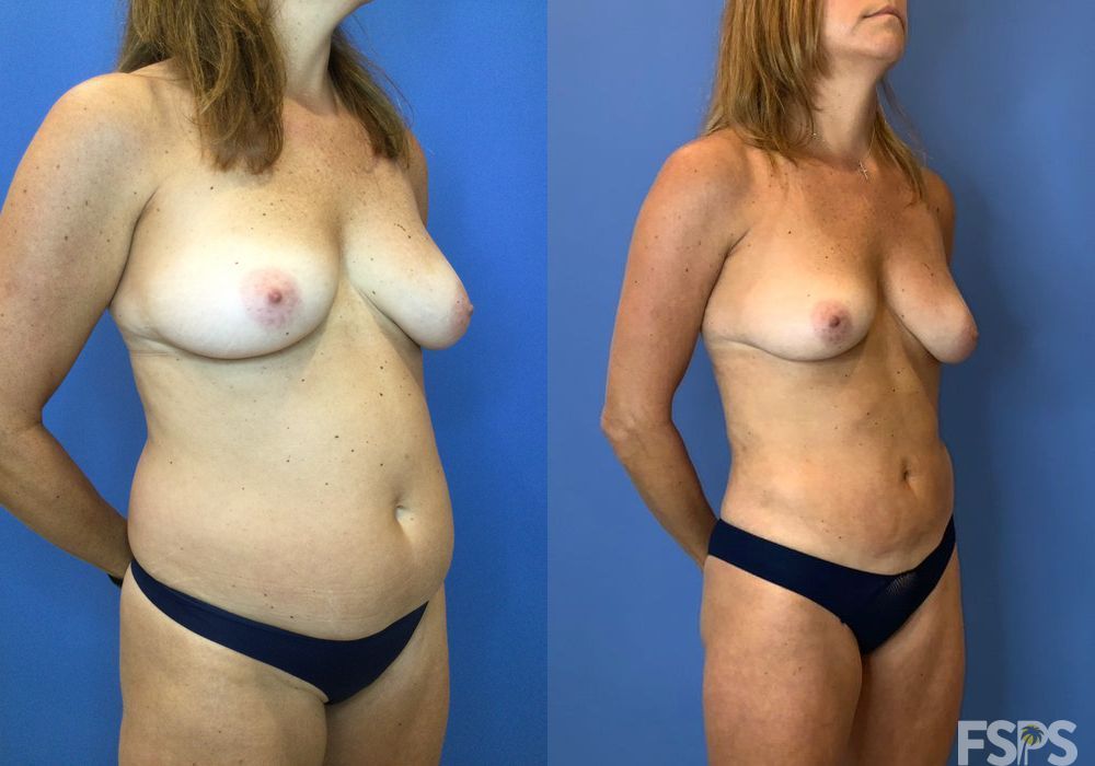 Liposuction - Thumbnail 4