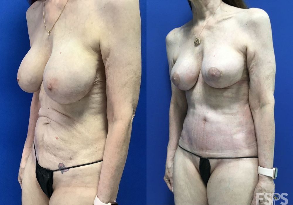 Breast Lift - Case 22661
