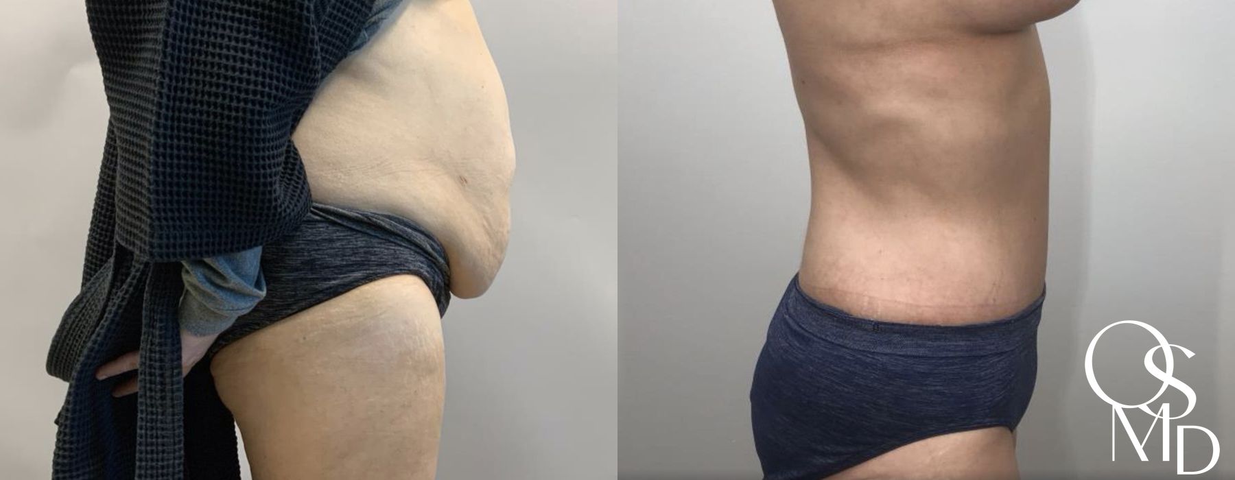 Before and after After Weight Loss case 16741 - Angle 5