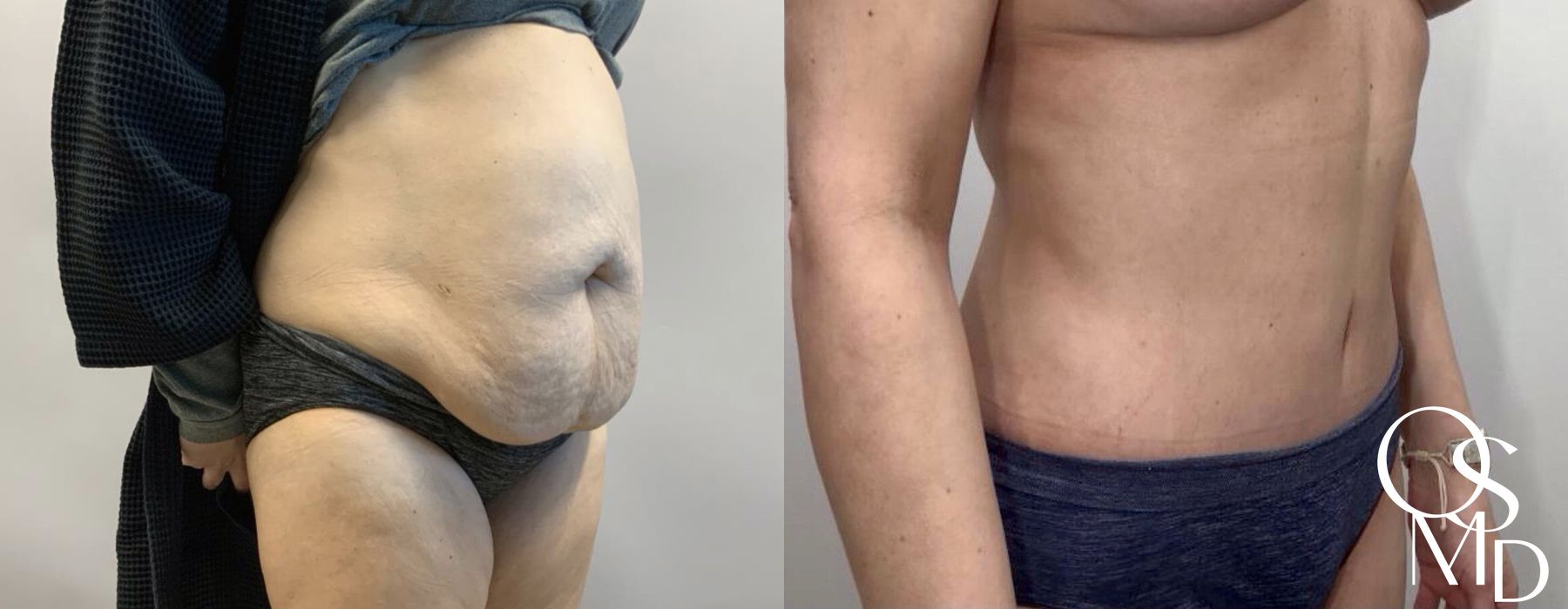 Before and after After Weight Loss case 16741 - Angle 3
