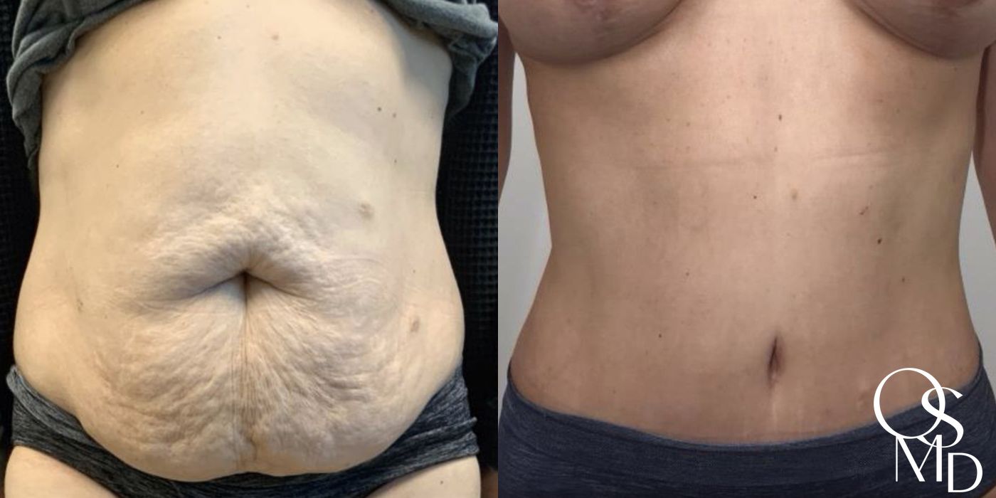 Before and after After Weight Loss case 16741