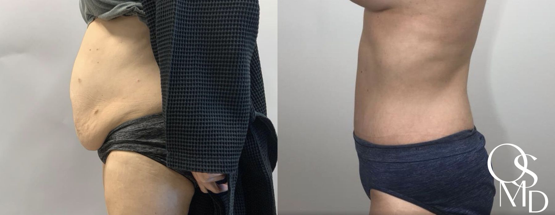 Before and after After Weight Loss case 16741 - Angle 4