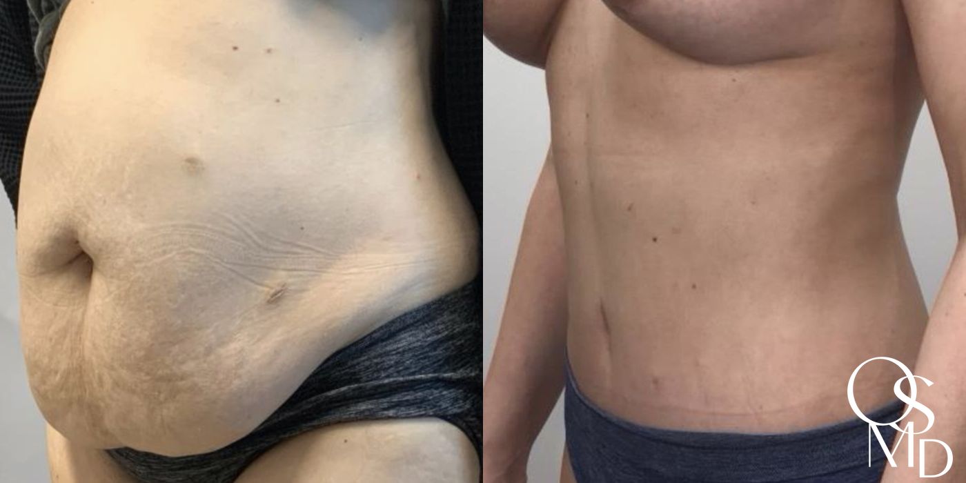 Before and after After Weight Loss case 16741 - Angle 2