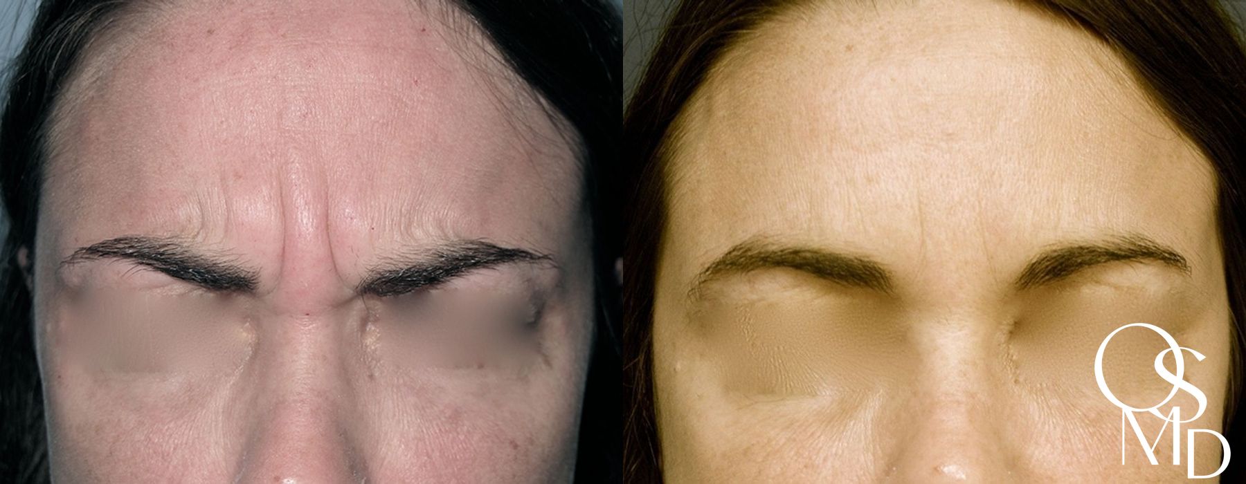 Before and after Botox/Dysport/Jeuveau case 16766