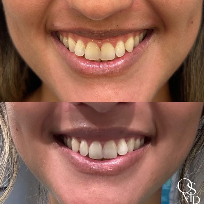 Before and after Botox/Dysport/Jeuveau case 18494