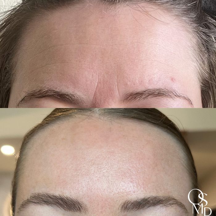 Before and after Botox/Dysport/Jeuveau case 18566