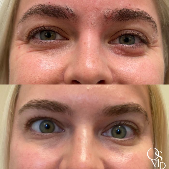 Before and after Botox/Dysport/Jeuveau case 19348