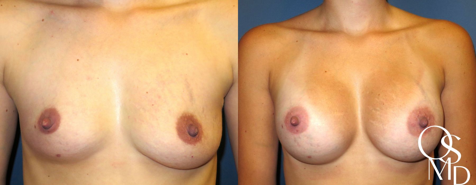 Before and after procedure result