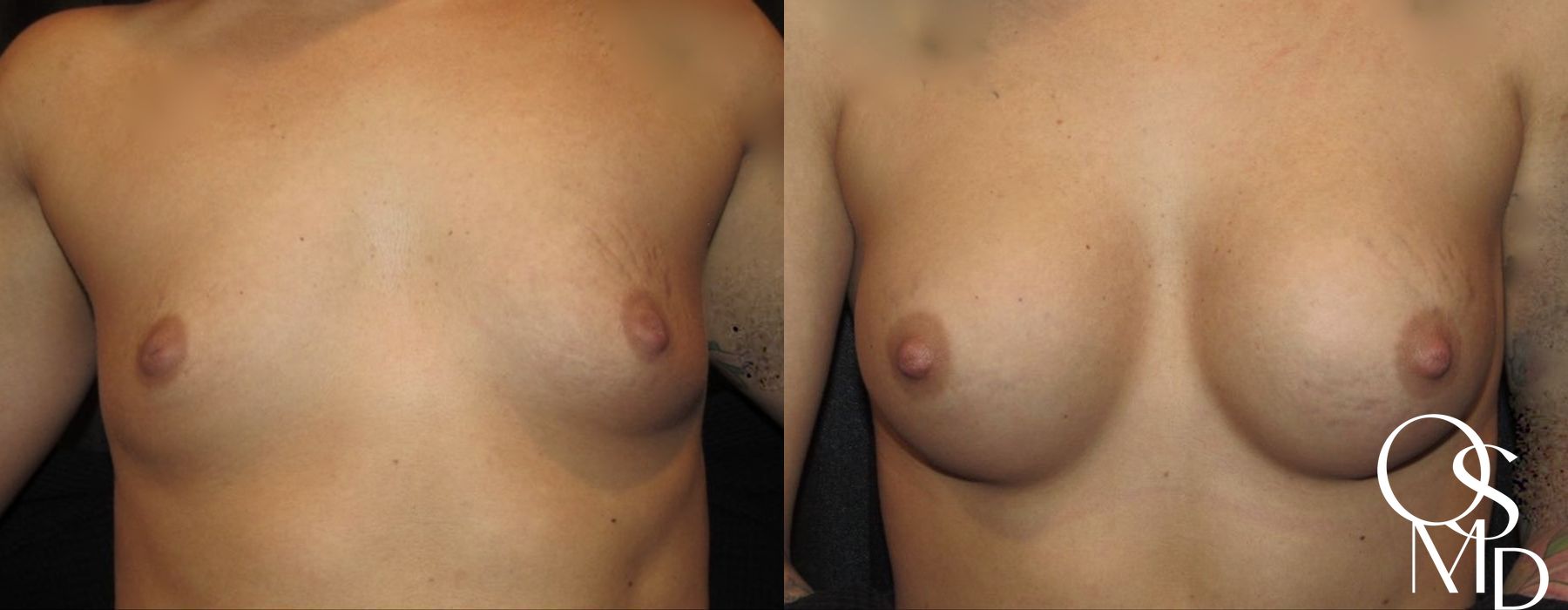 Before and after procedure result