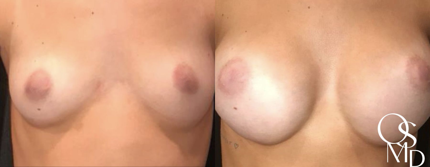 Before and after procedure result
