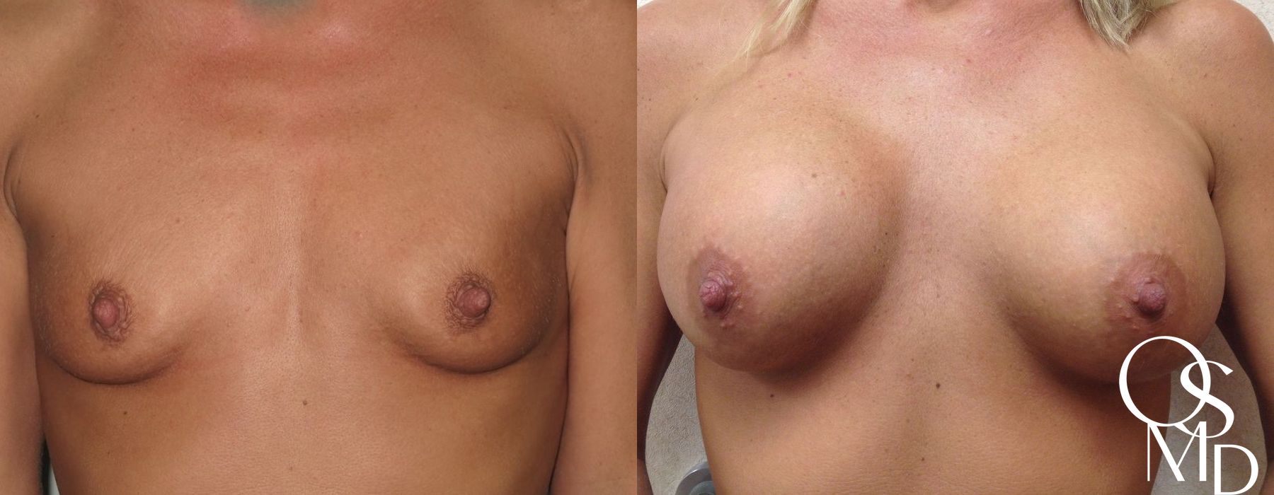 Before and after Breast Augmentation case 16761