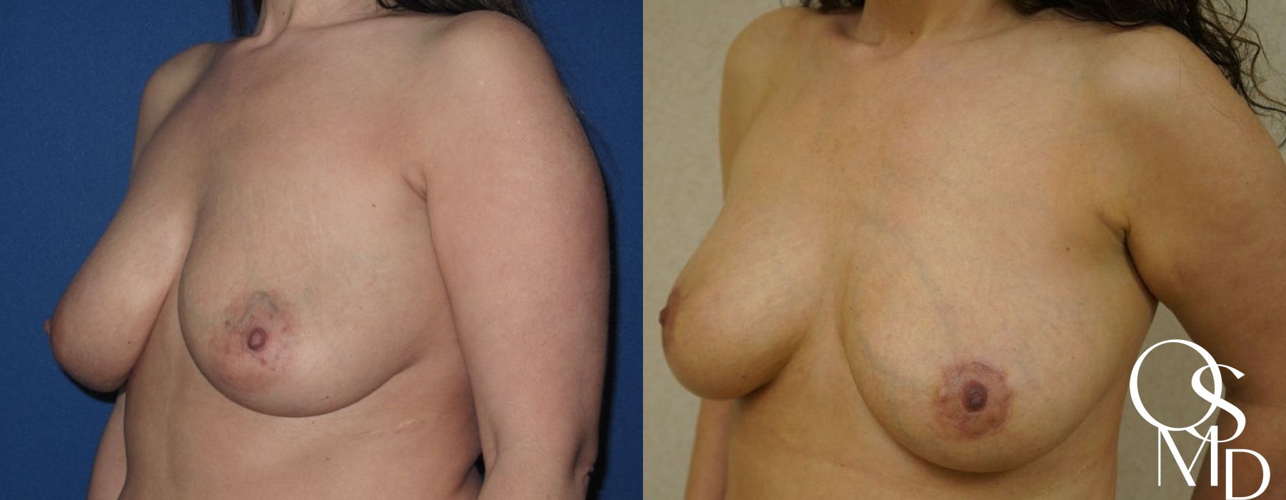 Before and after Breast Lift case 16763 - Angle 2