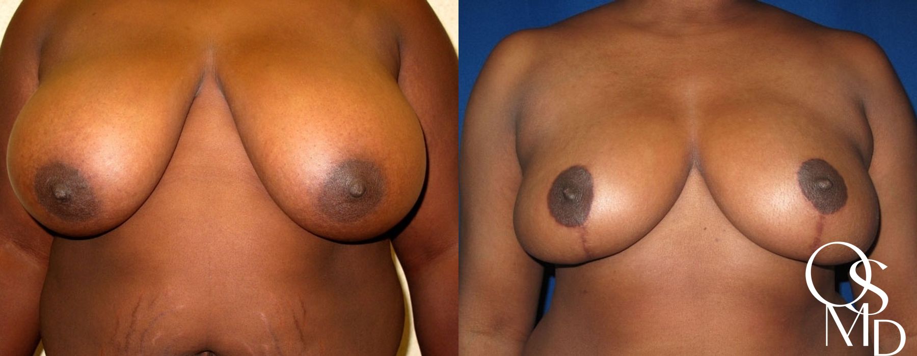 Before and after procedure result