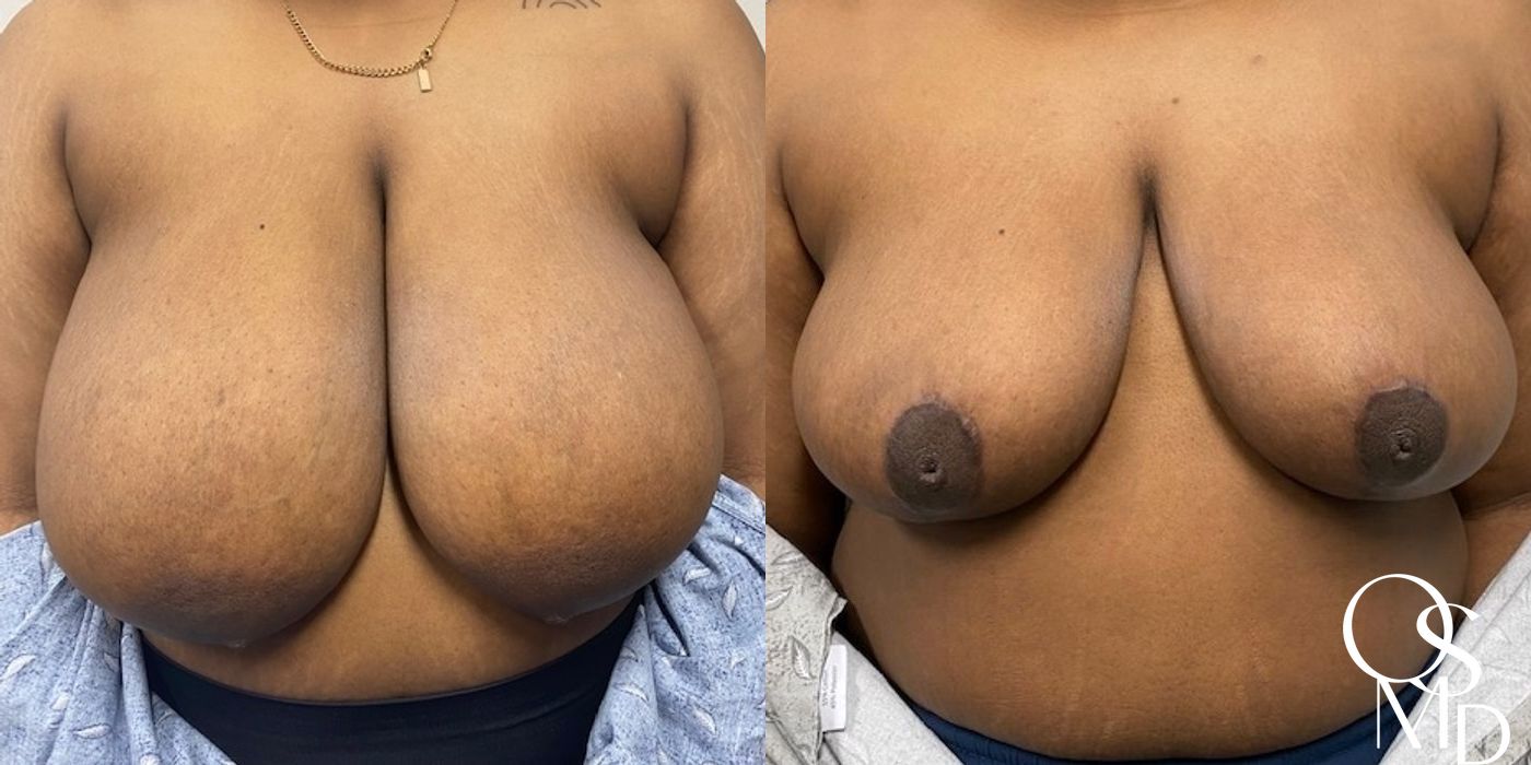 Before and after procedure result