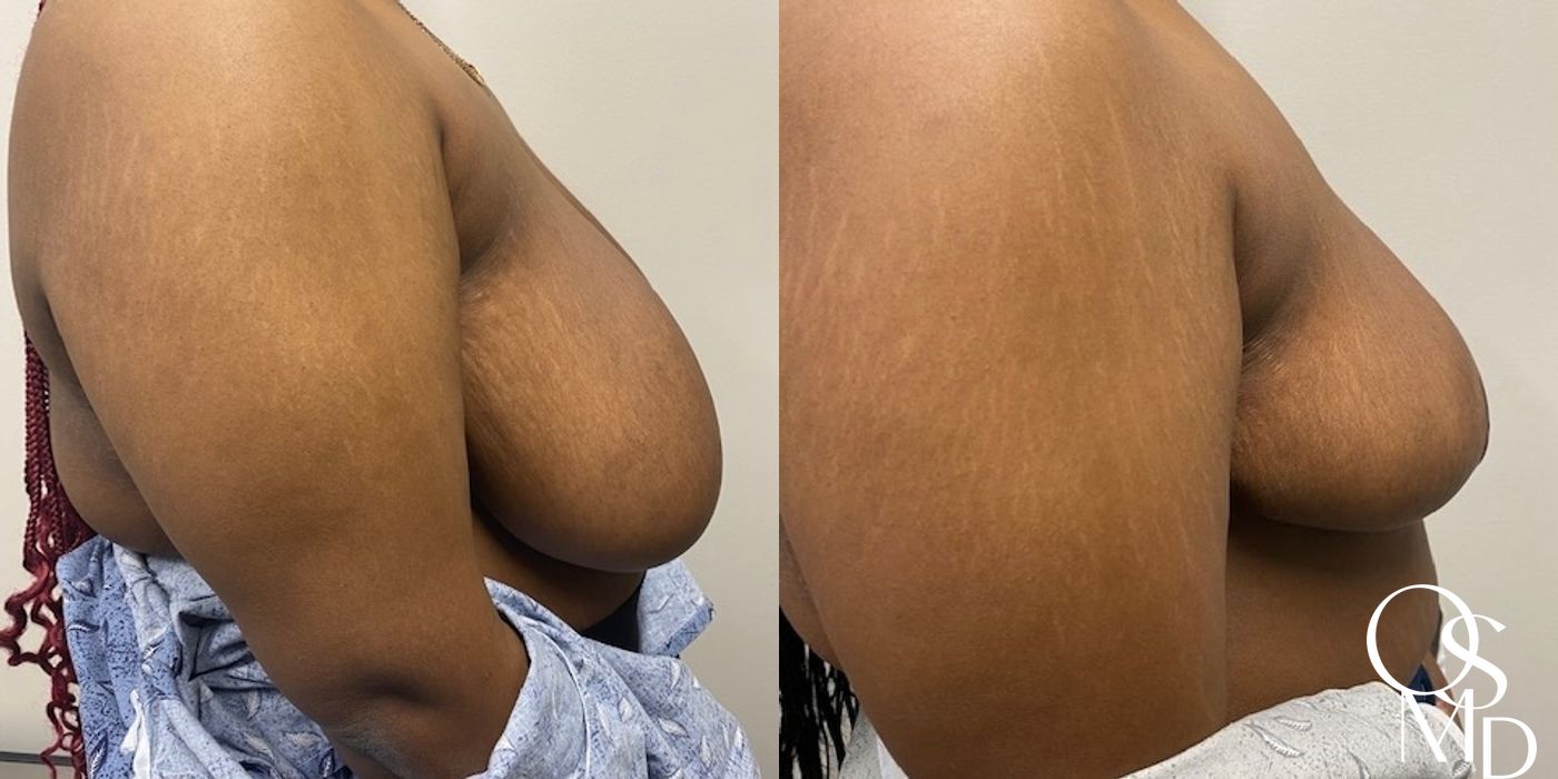 Before and after Breast Reduction case 16811 - Angle 2