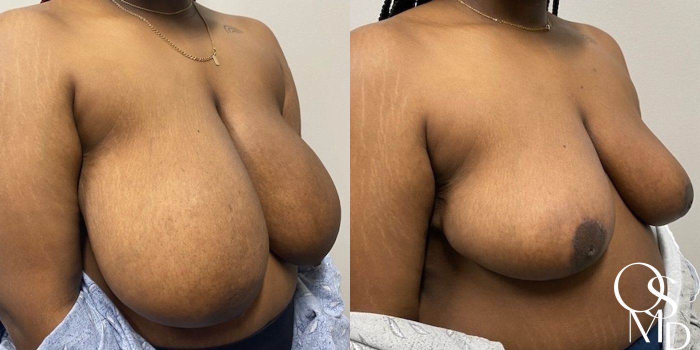 Before and after Breast Reduction case 16811 - Angle 3