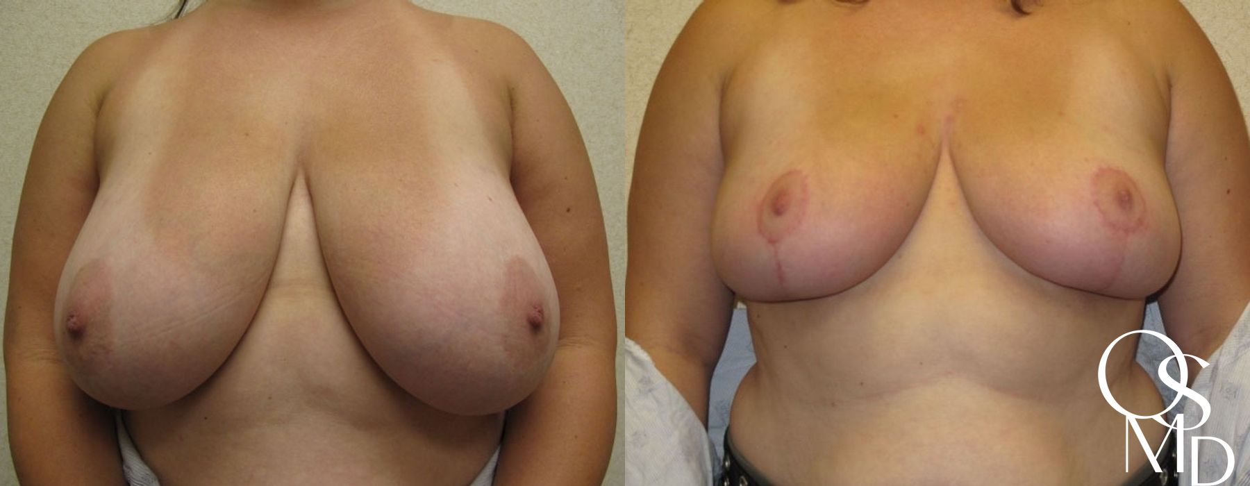 Before and after procedure result